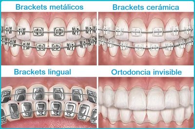 Mejora tu sonrisa con la nueva ortodoncia invisible