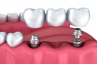 Implantes y dentaduras postizas